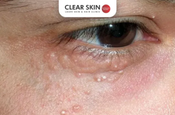 How to Identify Styes, Milia, and Pimples
