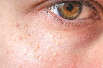How to Get Rid of Milia, Those Pesky, Unpoppable White Bumps