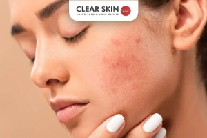 Filler Treatments for Acne Scars: A Complete Skincare Transformation Guide